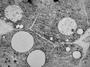 M,11y. | steatosis M,11y. | steatosis
